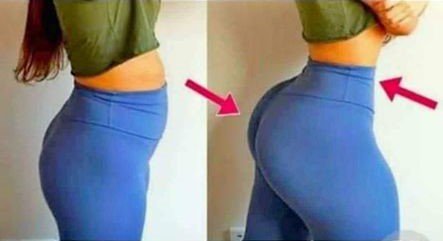 PMMA and Hydrogel Butt Injections In Nairobi Kenya+27 74 676 7021