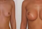 BREASTS ENHANCEMENTS AND FIRMING IN GABORONE BOTSWANA+27 74 676 7021