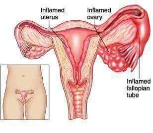 Vaginal odor herbs, vaginal dryness herbs, vaginal thrush herbs in Maseru Lesotho+27 74 676 7021